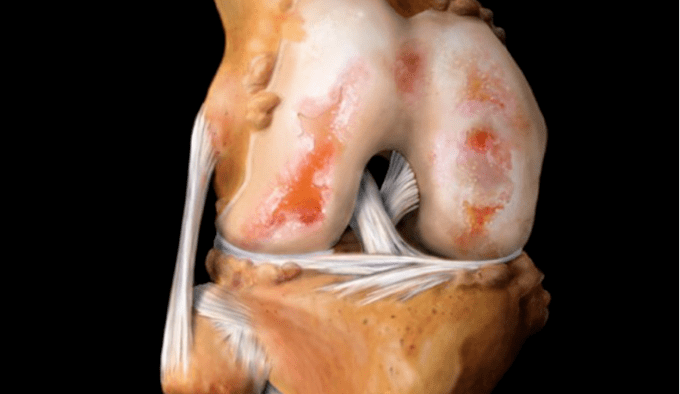 belauneko artikulazioko artrosia