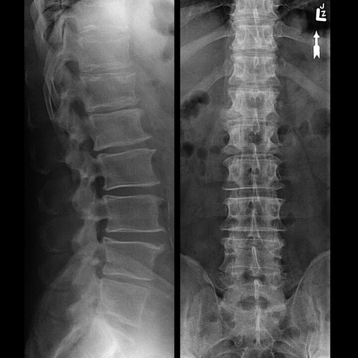 Bizkarrezurra Bizkarrezurra Osteokondrosia