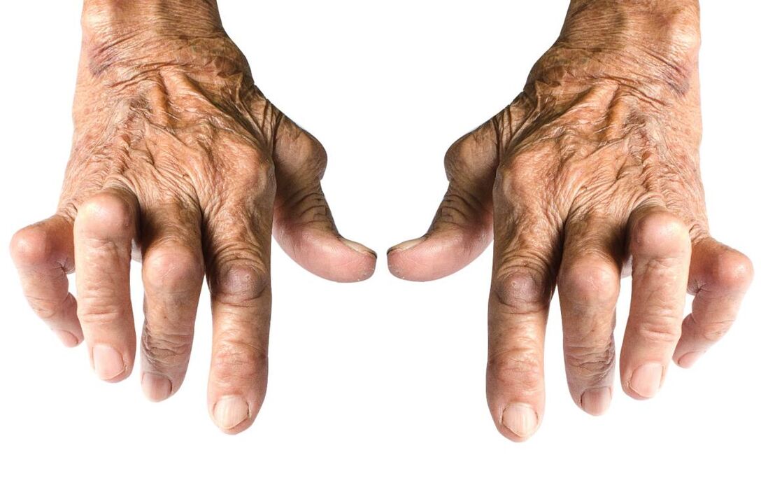 artritisaren seinaleak - artikulazio deformazioa
